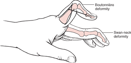 diagram showing swann neck and boutonniere deformities