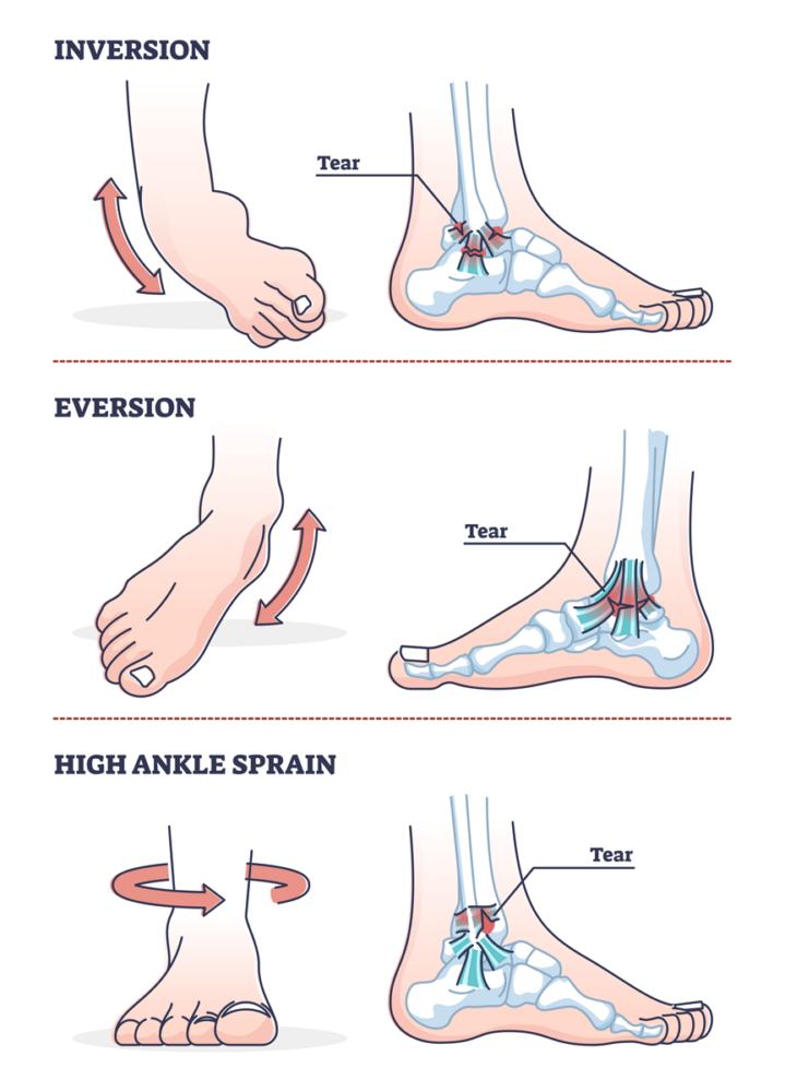 labeled illustrations of ankle sprains