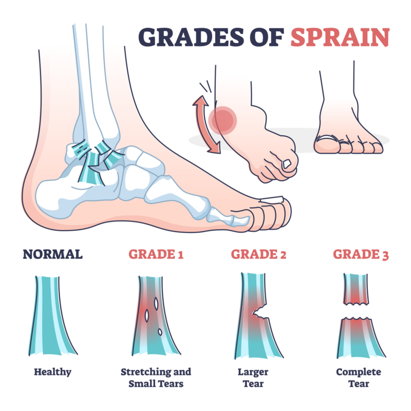 grades of ankle sprains